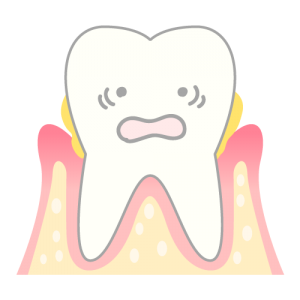 歯周病の歯のイラスト