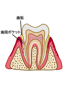 歯周病