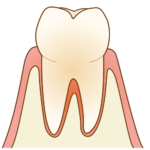 健康な歯肉