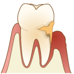 軽度歯周炎