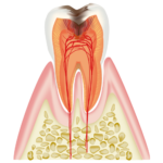 虫歯が歯髄にまで達した歯の断面図