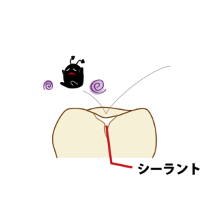 虫歯を寄せつけないシーラント
