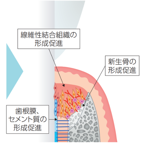 フラップ手術後の経過