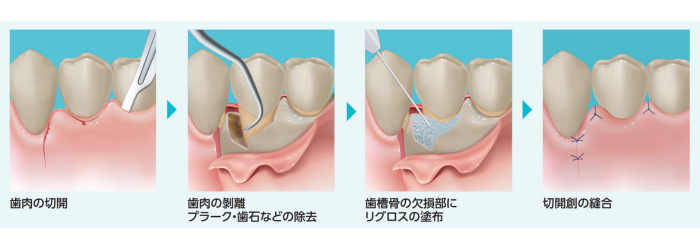 フラップ手術におけるリグロスの塗布