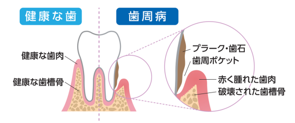 歯周病の進行