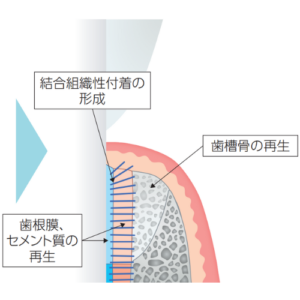 歯周組織再生